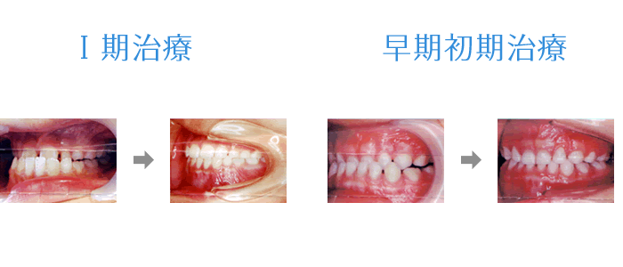 小児の矯正治療