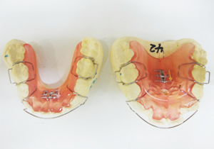 小児の矯正治療